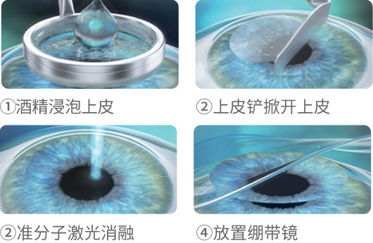 準分子激光近視手術(shù)